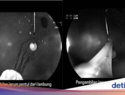 Detik-detik Praktisi Medis Senior FKUI Keluarkan Jarum Pentul Untuk Lambung