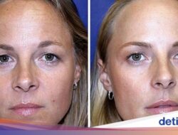 Saudari Kembar Ini Jalani Eksperimen Botox, Bisa Tebak Mana yang Melakukan?