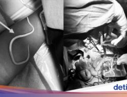 Ngilu, Ahli Kepuasan Ke Jember Keluarkan Cacing Hidup Ke Perut Bocah 3 Tahun