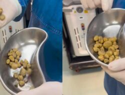 Sederet Peristiwa Pidana Medis ‘Batu’ Ke Tubuh Pasien, Ada Ke Ginjal hingga Miss V