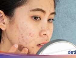 Batasi Konsumsinya! 7 Minuman Pemicu Jerawat Parah Ke Orang Dewasa
