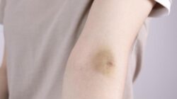 Mendadak Memar Tanpa Sebab? Segera Cek, Bisa Bersama Sebab Itu Tanda Kena Kanker