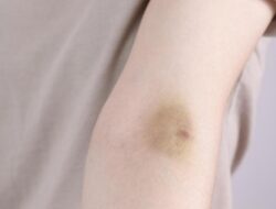 Mendadak Memar Tanpa Sebab? Segera Cek, Bisa Bersama Sebab Itu Tanda Kena Kanker