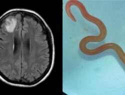 Ngeri, Praktisi Medis Temukan Cacing Parasit Ular Piton 8 Cm Ke Otak Wanita Australia