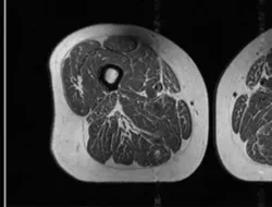 Potret Makanan UPF Bikin Paha Manusia Mirip Daging Berlemak, Seserius Ini Efeknya